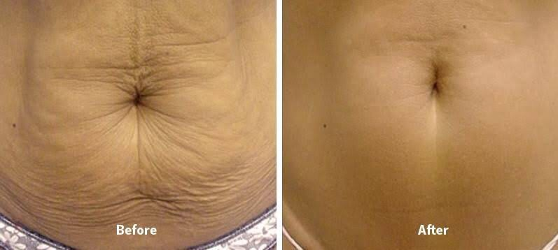 Thermage Belly Fat Reduction