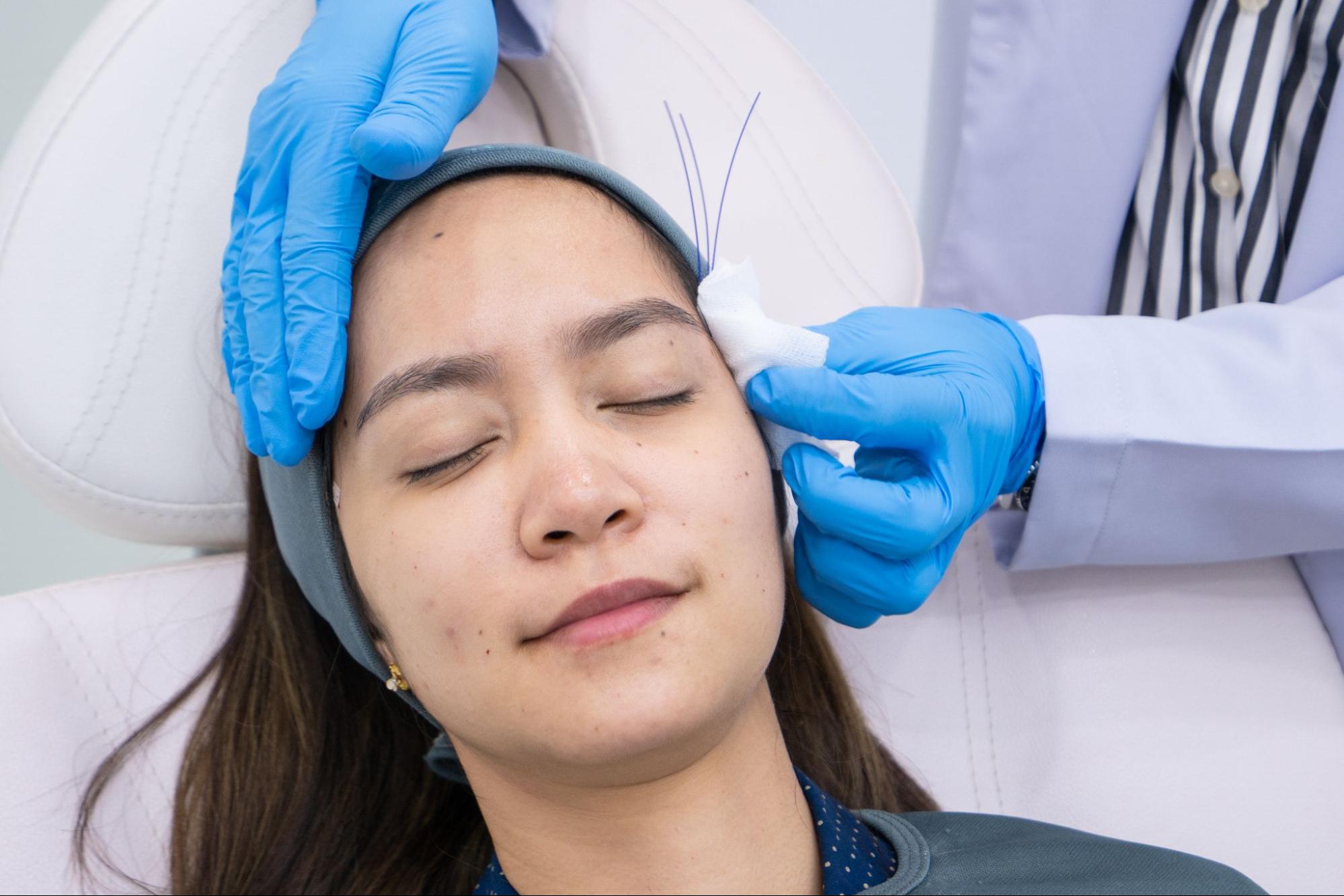 Thread lift for facial collagen stimulation