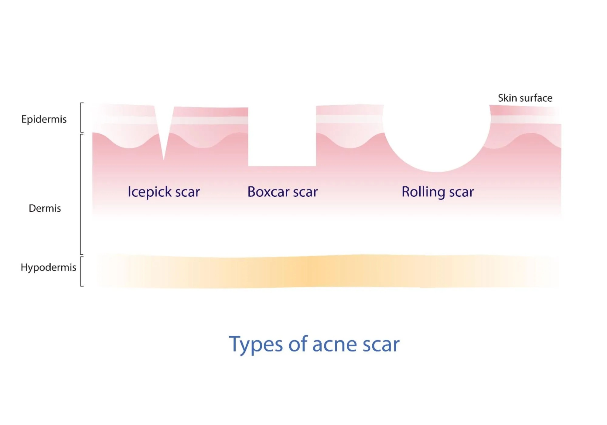 Types of Acne Scars