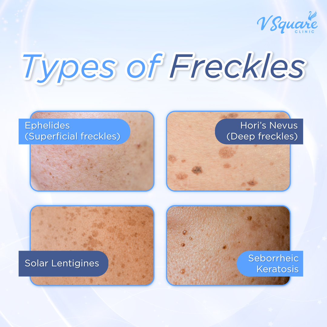 Types of freckles