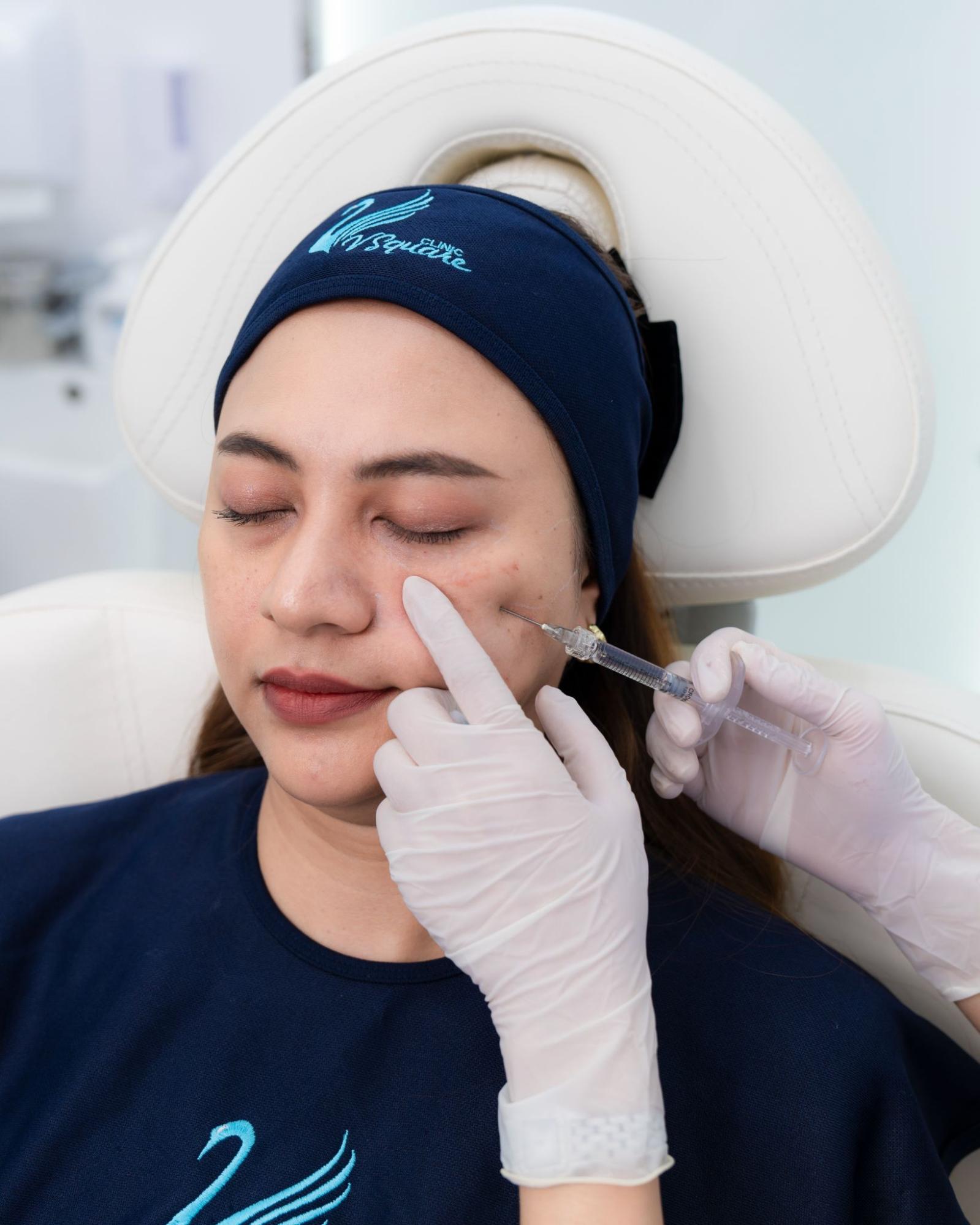 Under-eye filler injection