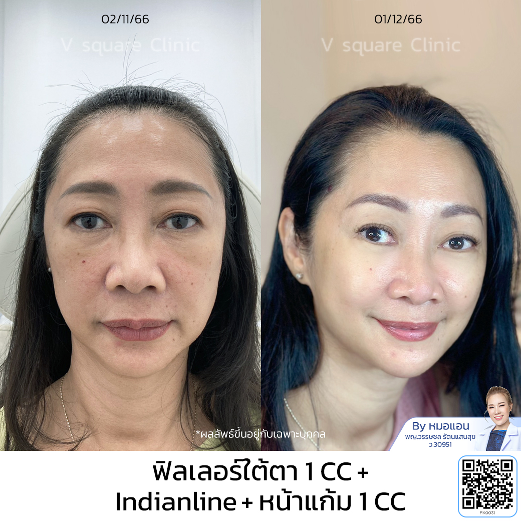 Under eye filler review V Square Clinic_คุณกฤติกา โดย หมอ แอน