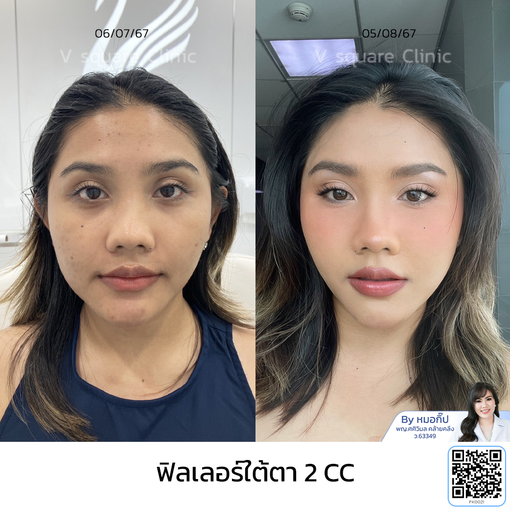Under eye filler review V Square Clinic_คุณเพลง อินฟลู โดย หมอ กิ๊ป