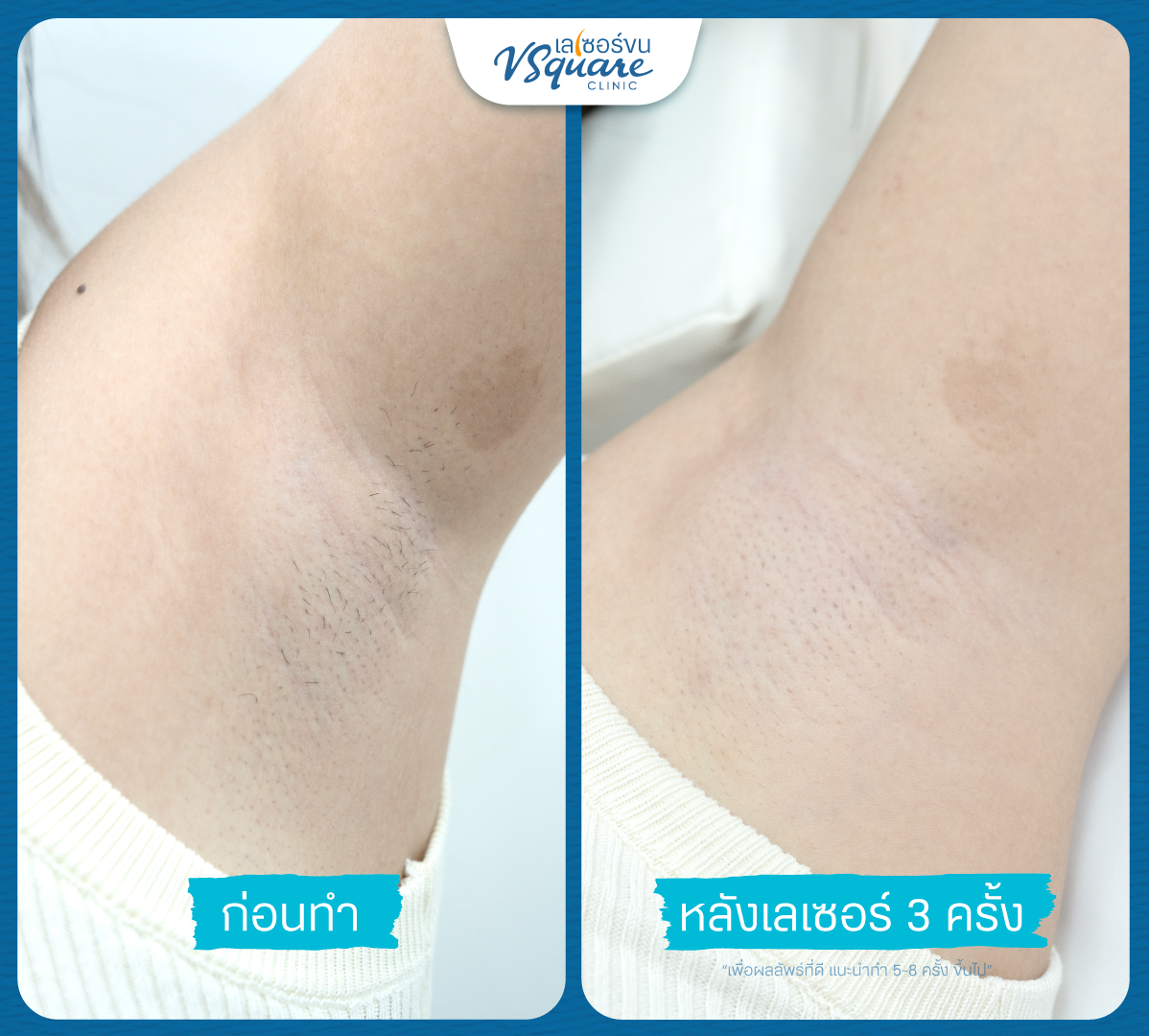 Underarm laser hair removal review