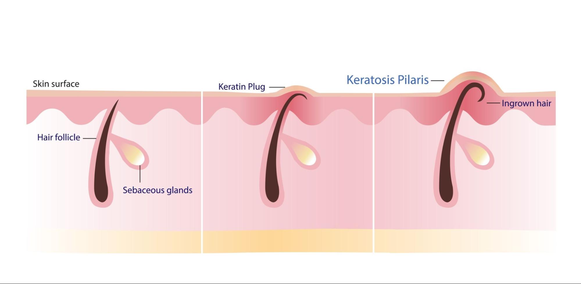 What does ingrown hair look like