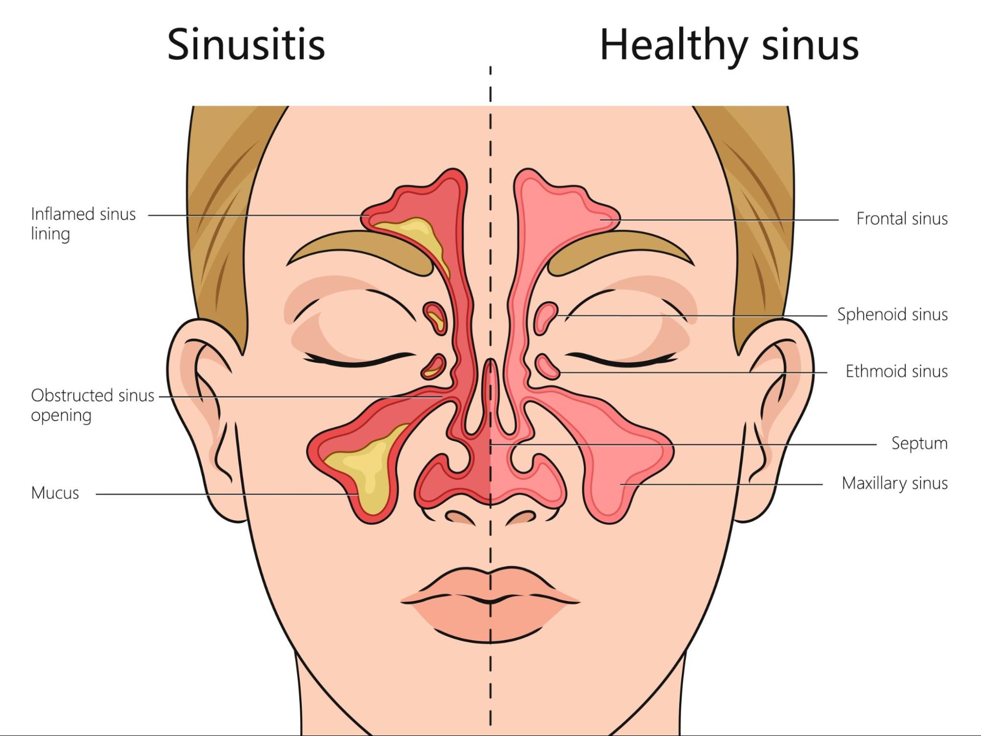What is Sinusitis