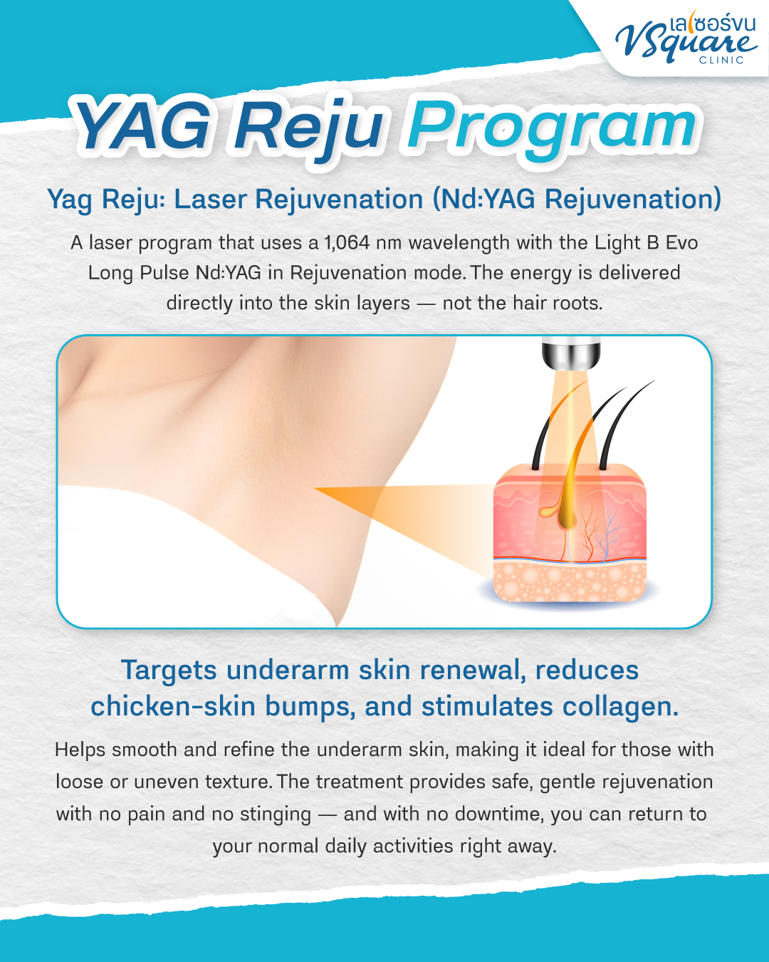 What is Yag Reju Laser Rejuvenation