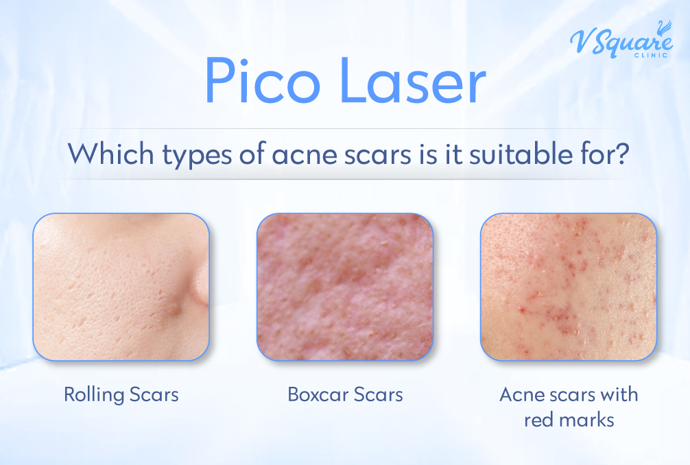 What type of acne scars is Pico Laser suitable for
