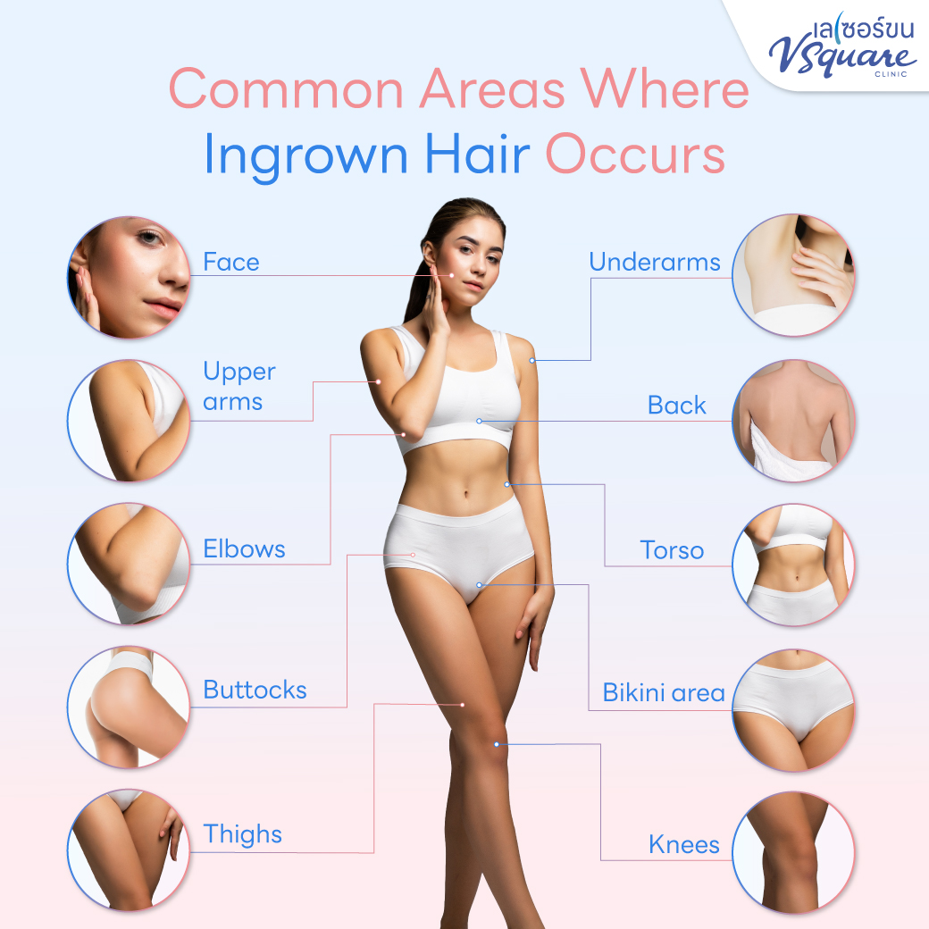 Where can ingrown hair occur