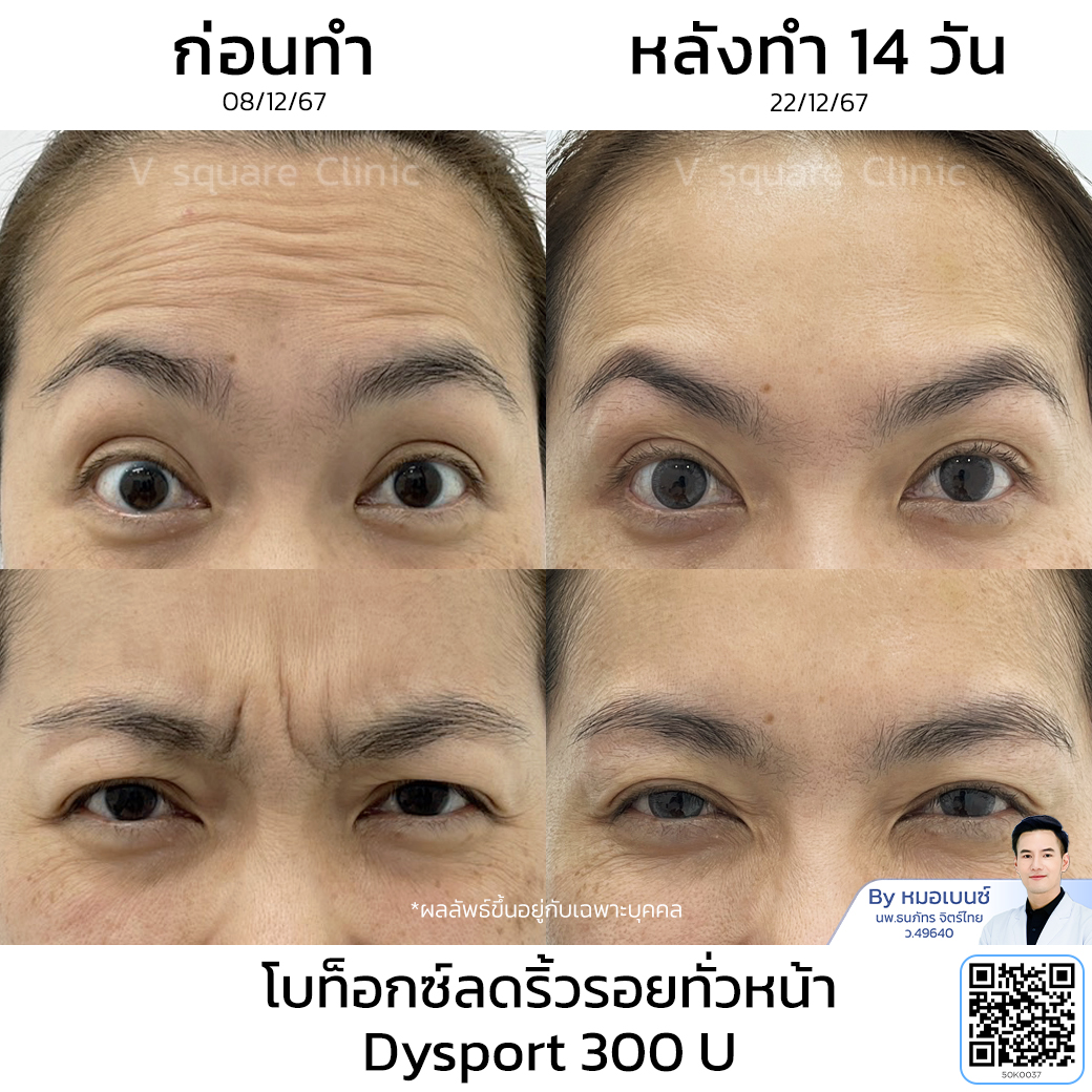 Wrinkle Botox review_คุณจุฑามาศ โดย หมอเบนซ์