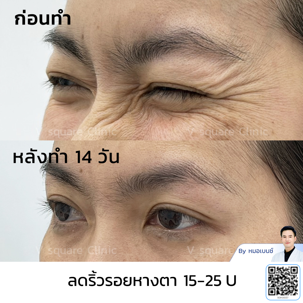 Wrinkle Botox review_คุณจุฑามาศ โดย หมอเบนซ์