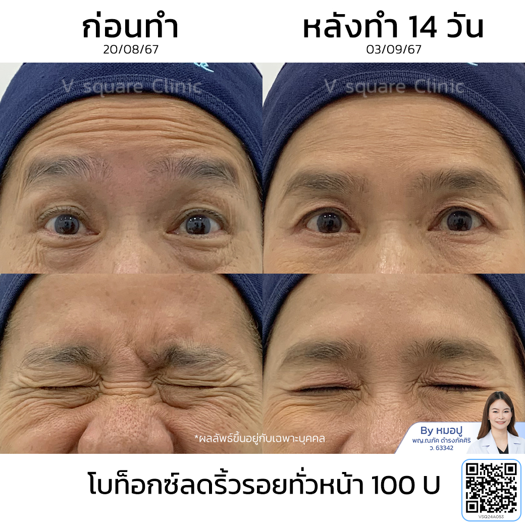 Wrinkle Botox review_คุณชมพู่ โดย หมอ ปู