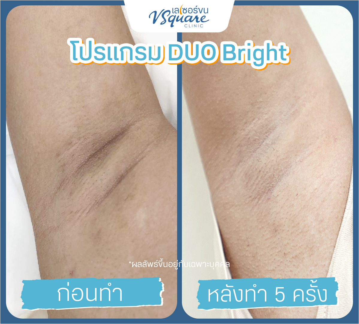 Yag Reju Duo Bright results before–after