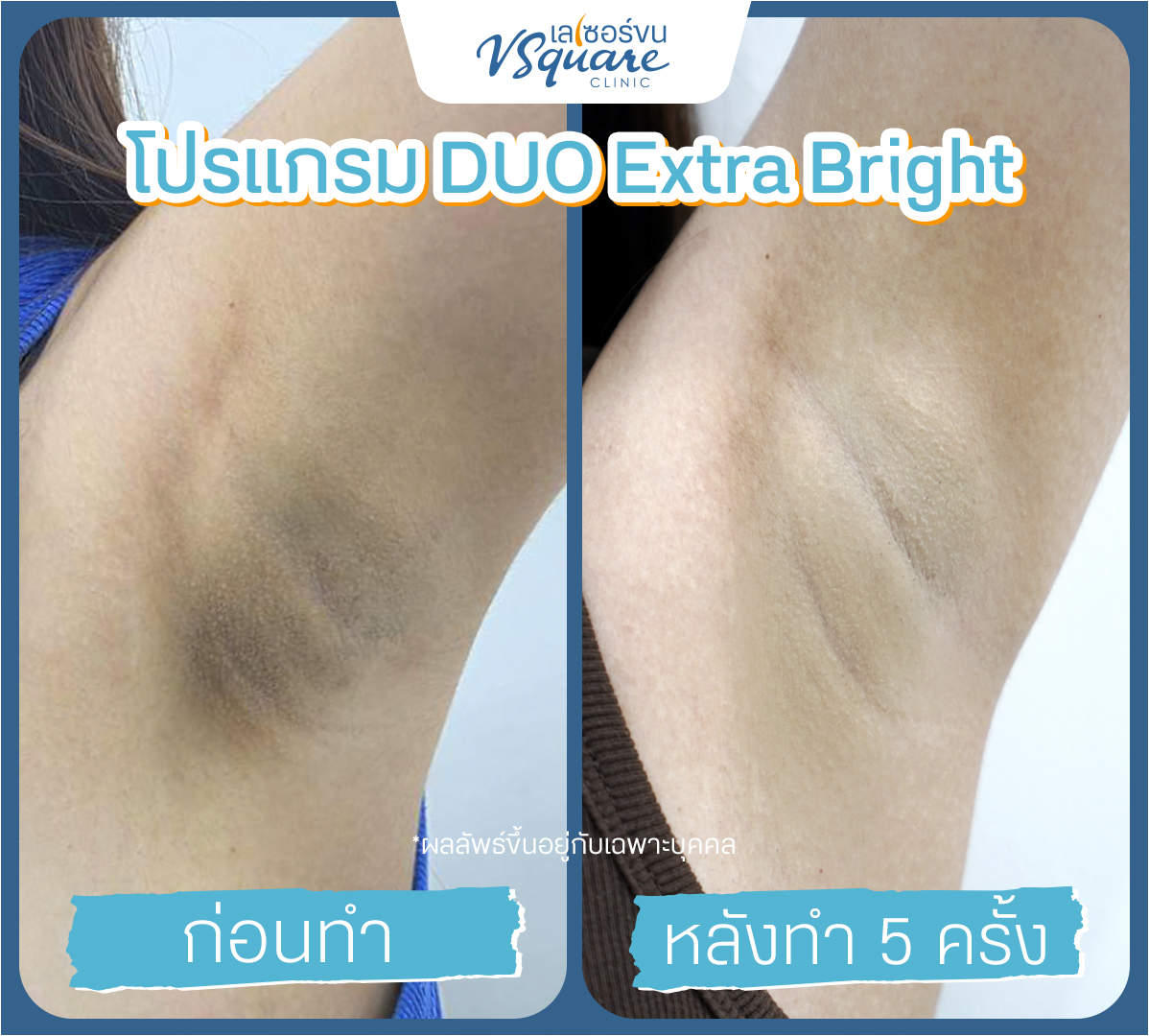 Yag Reju Duo Extra Bright results before–after