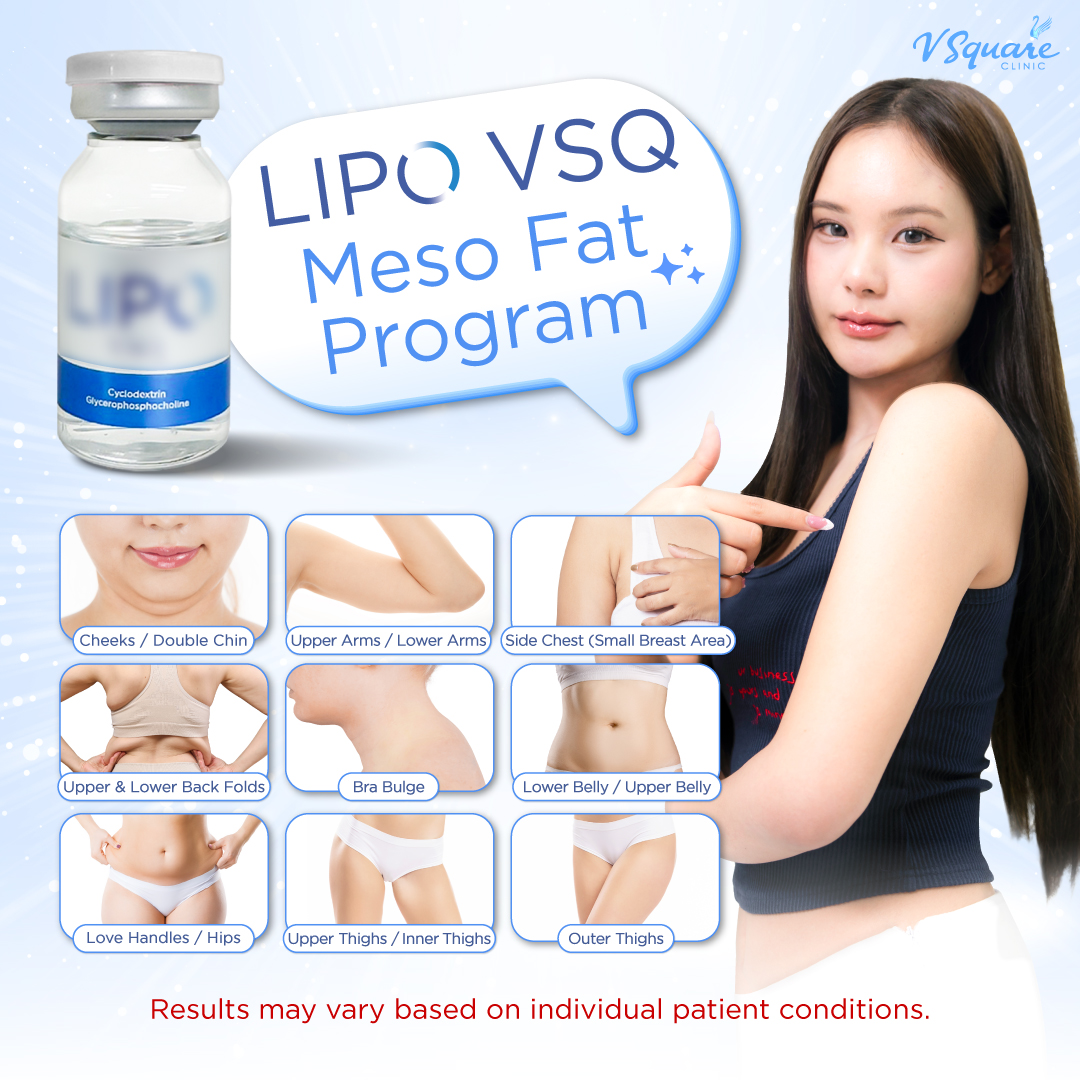 mesofat injection areas