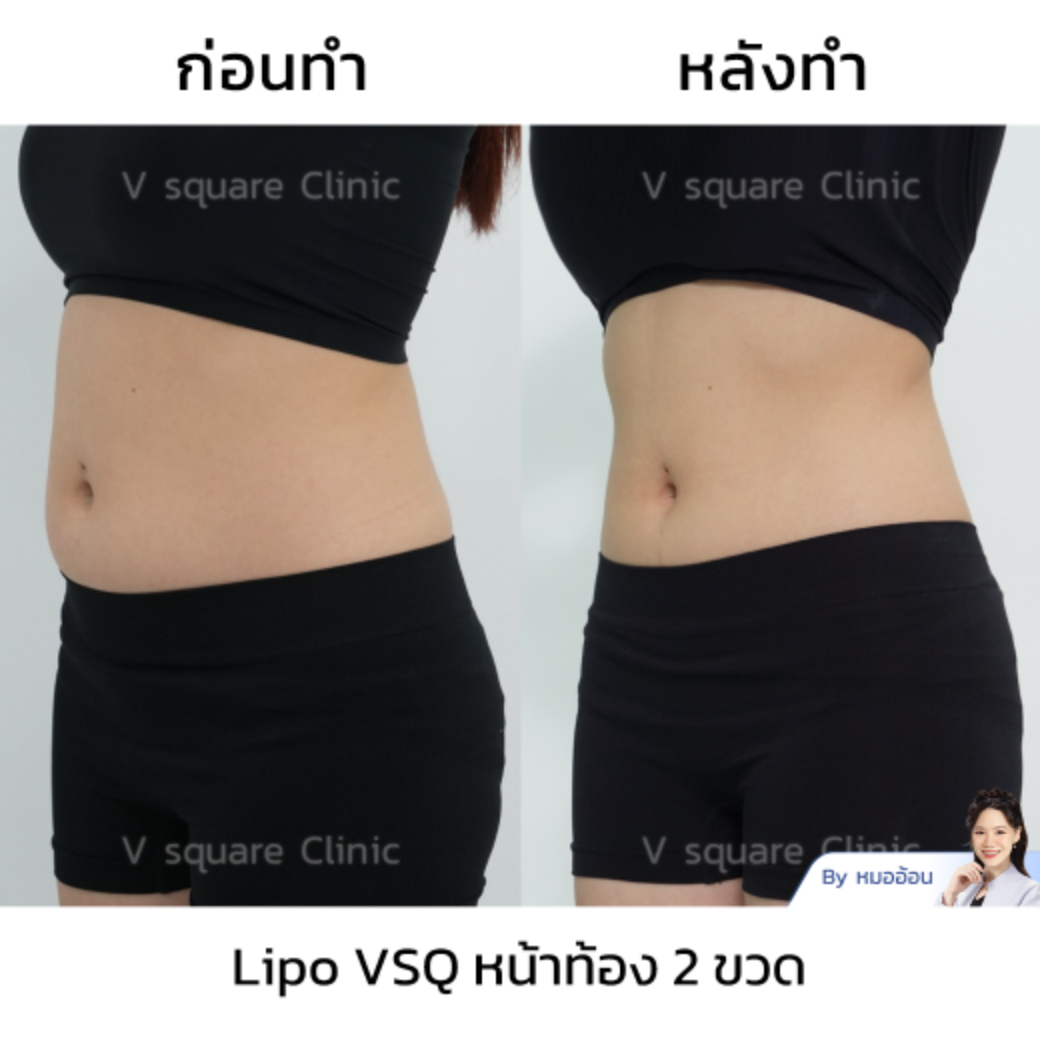 mesofat stomach review_คุณแคท by Dr.Isada Trakulsuk