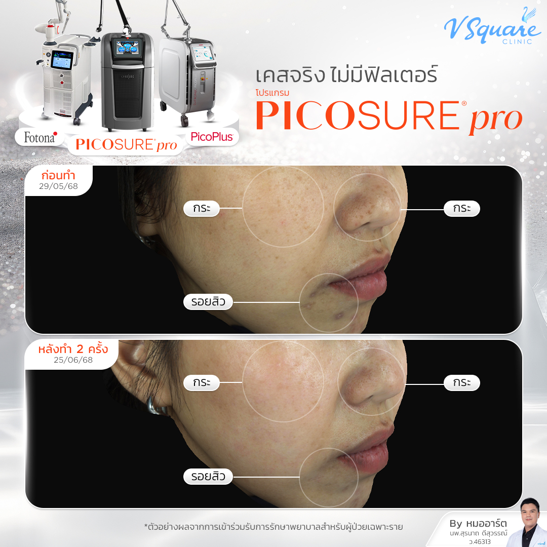review pico laser โดย Pico Laser Treatment at V Square Clinic โดย Dr.Suranart Deesuwan